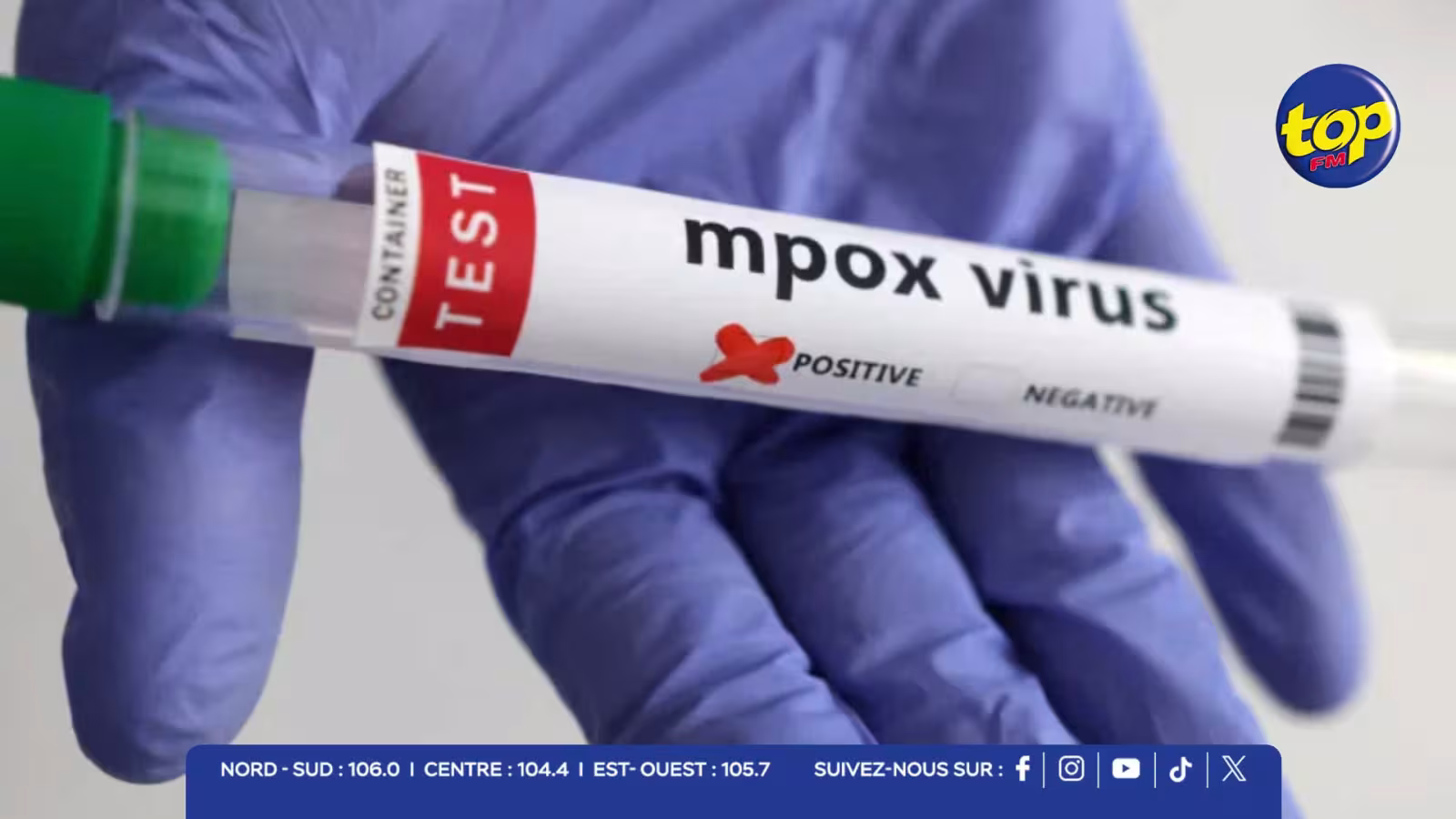 Mpox : un cas suspect placé en isolement à l’hôpital du Nord