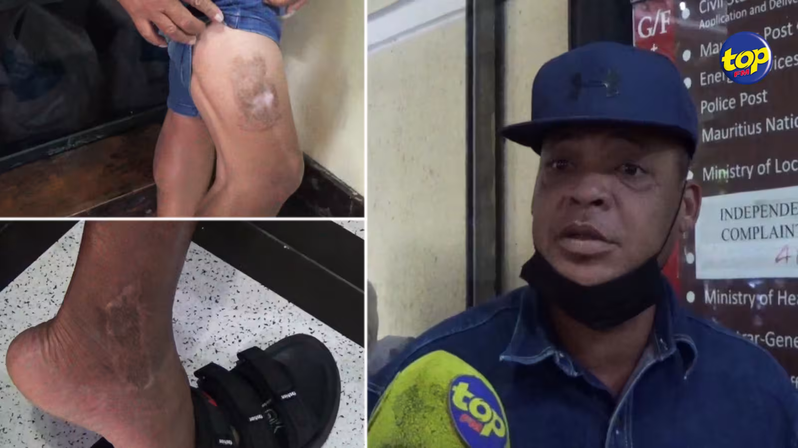 Brutalité policière alléguée : « Zot ine craze mo cheville… c’est après plus ki enn semaine ki zot ine amen moi l’hôpital », déplore Gérard Noël Catapermal…