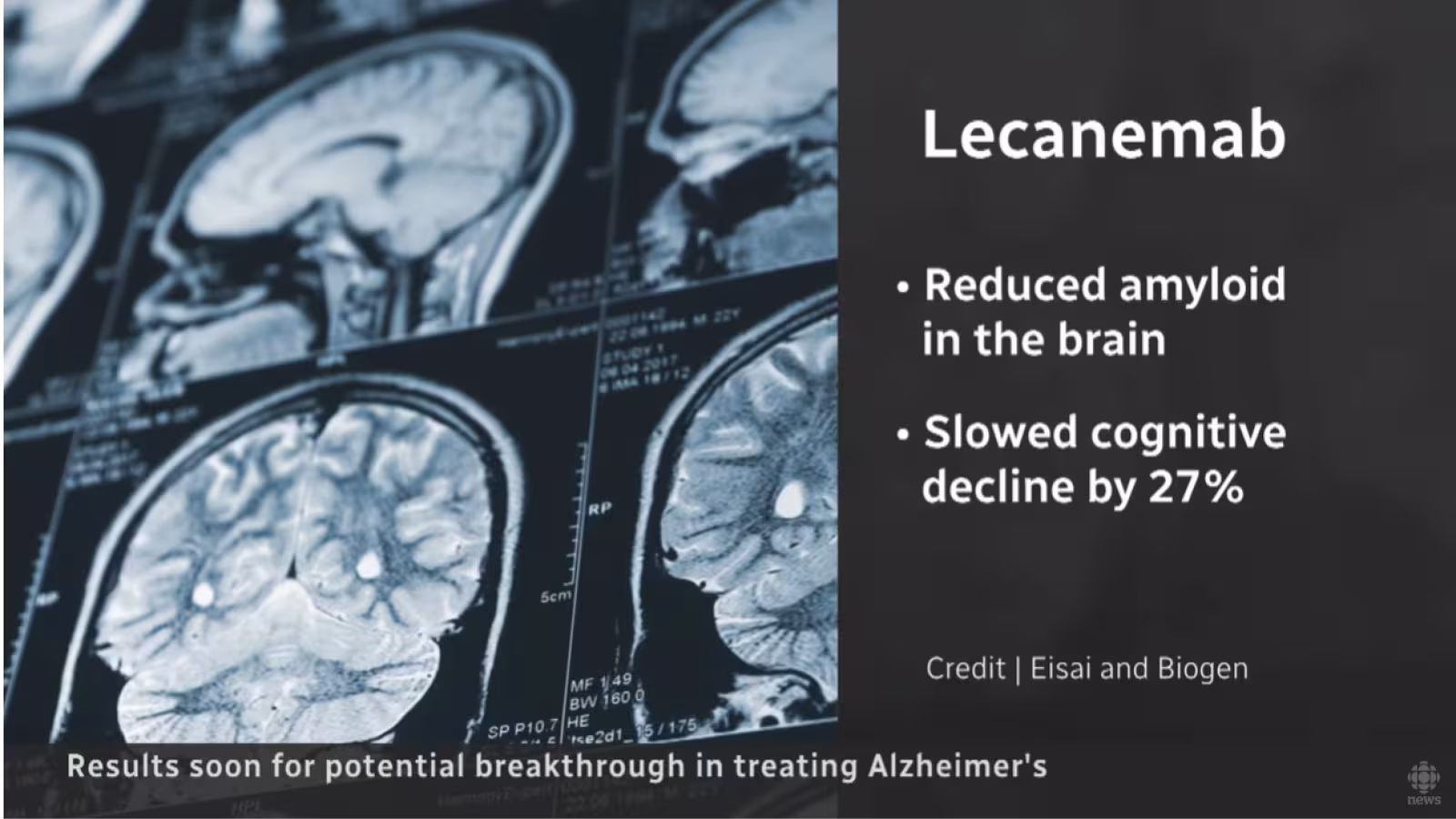Un traitement enfin trouvé contre la maladie d’Alzheimer