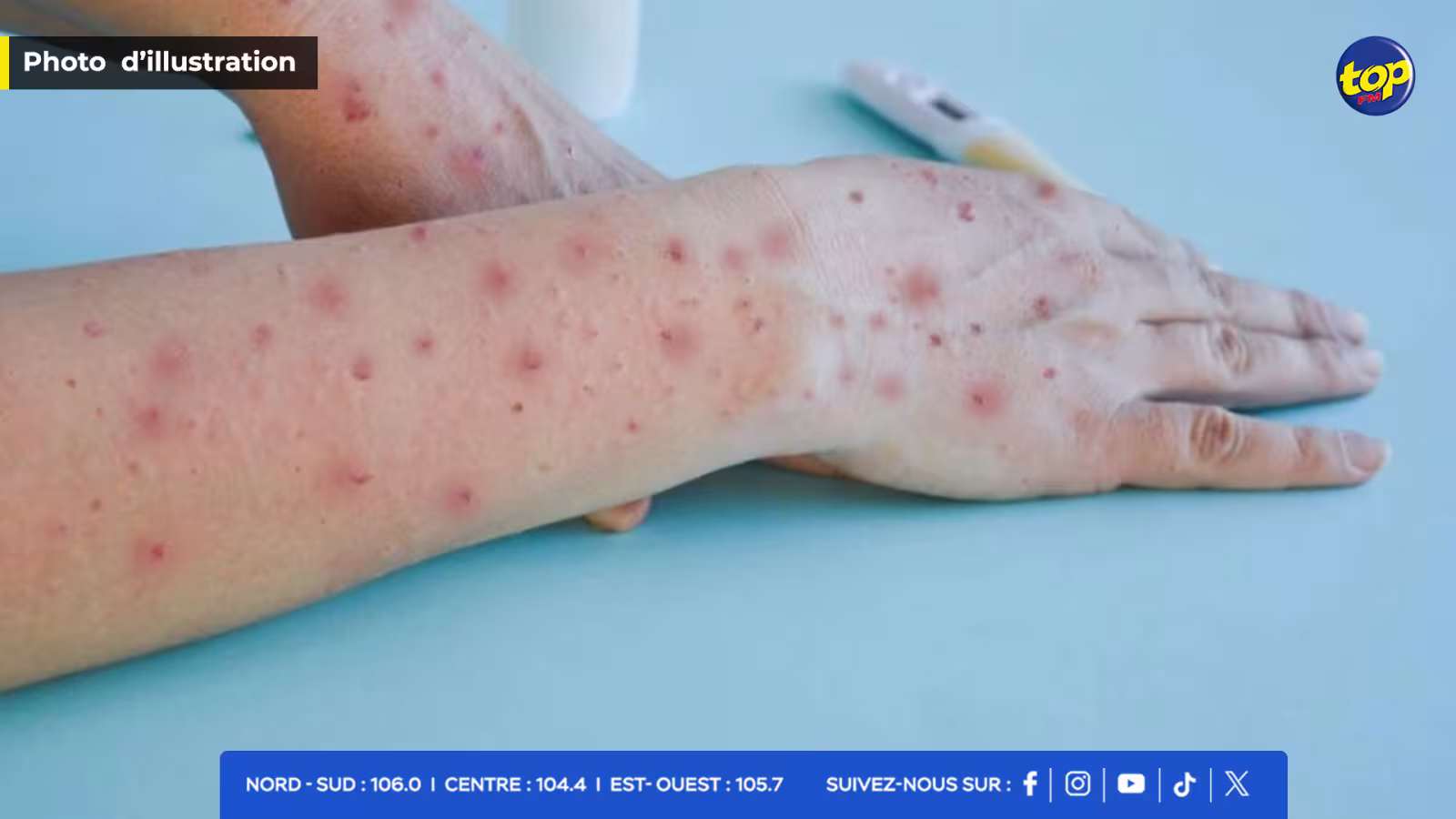 MPOX