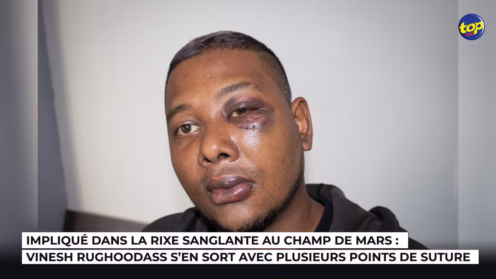 Impliqué dans la rixe sanglante au Champ de Mars : Vinesh Rughoodass s’en sort avec plusieurs points de suture
