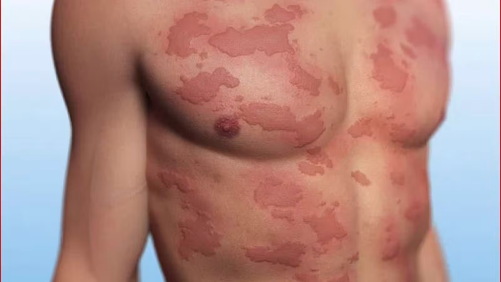 Forte allergie au vaccin Pfizer : une infirmière se retrouve aux urgences