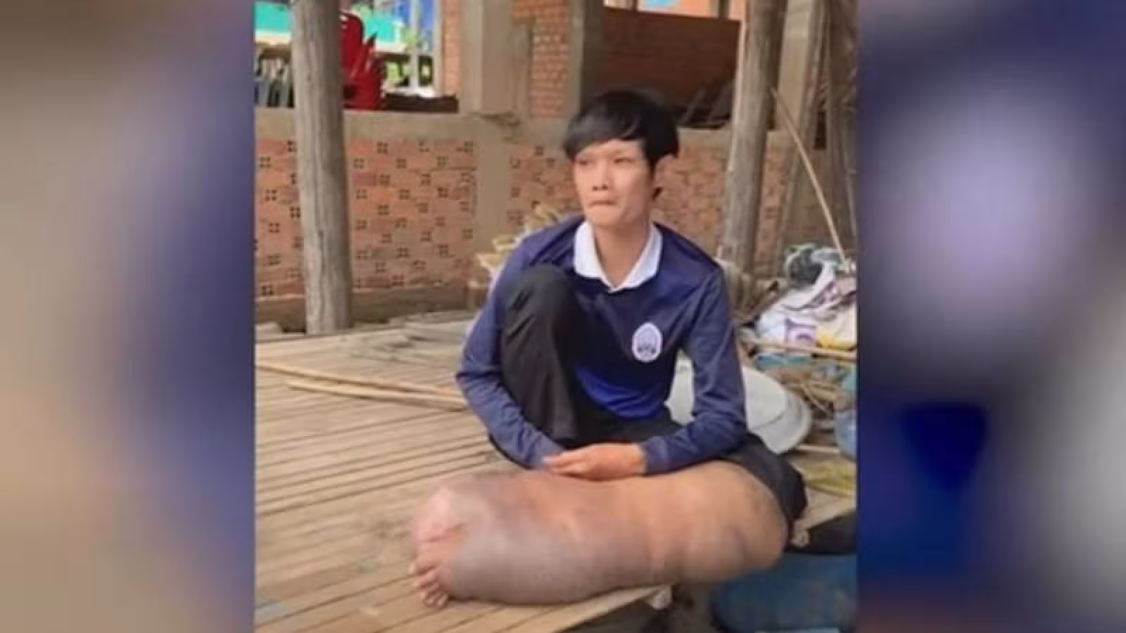 Une piqûre de moustique a changé sa vie à tout jamais