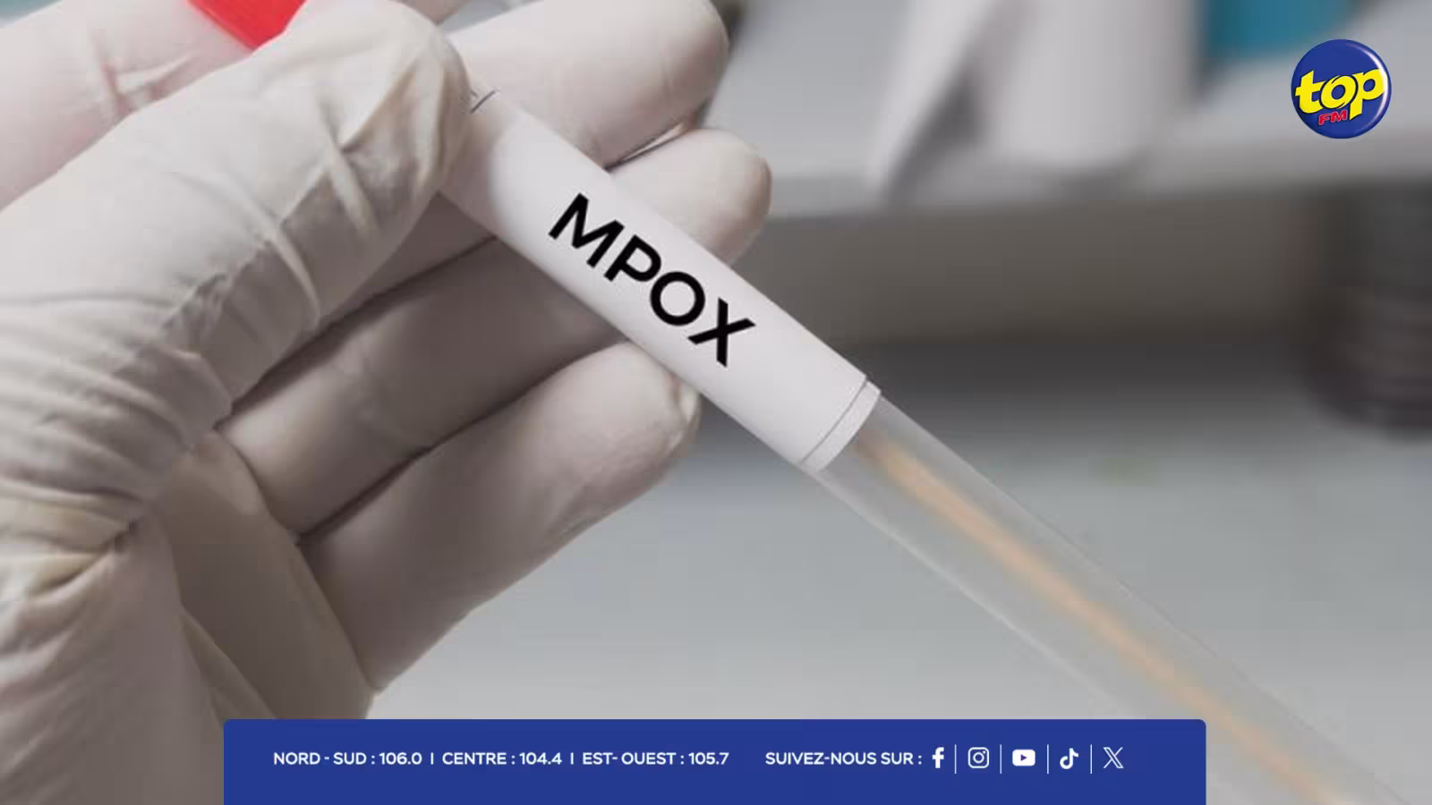 Mpox à Maurice : deux cas suspects isolés à l’hôpital Victoria, résultats attendus sous-peu