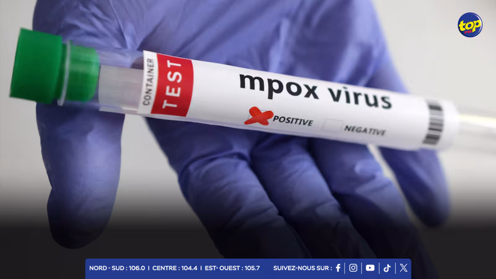 Troisième cas de Mpox ? : le ministère de la Santé dément les rumeurs