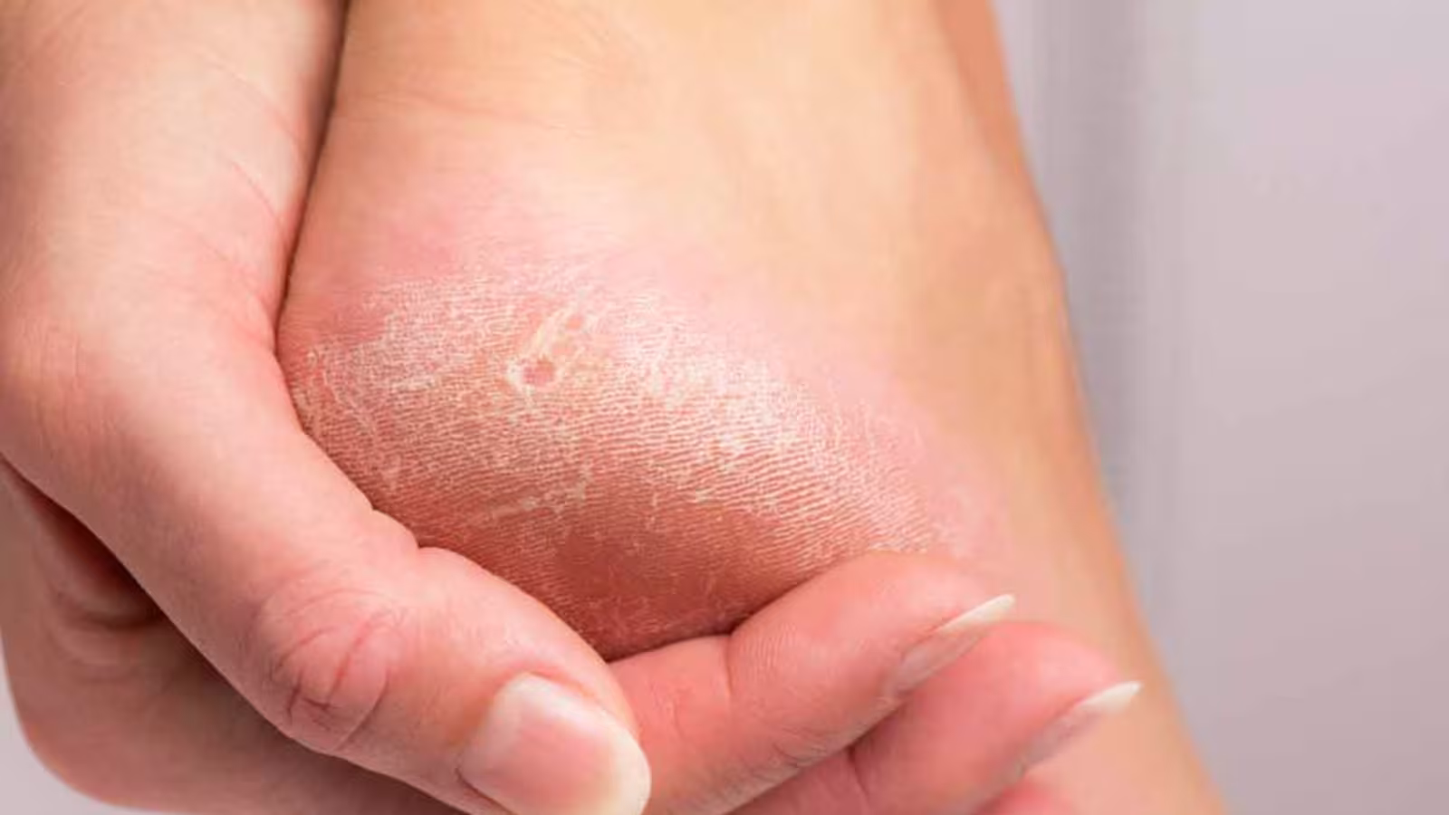 De l’ail pour prendre soin de ses pieds