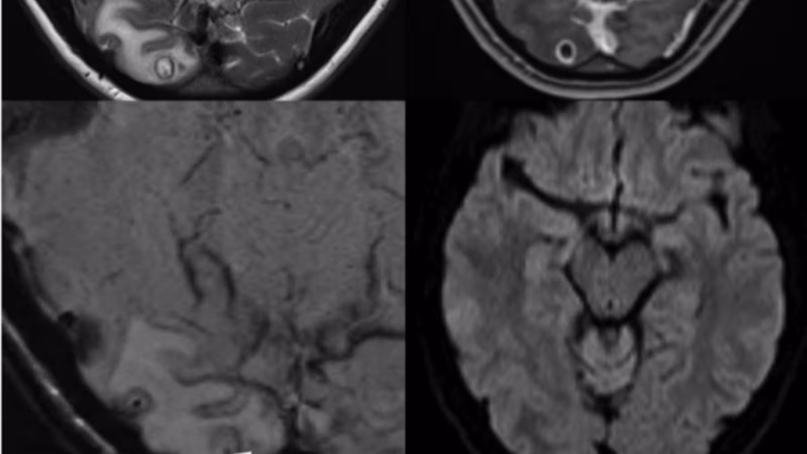 Une Australienne souffrant de migraines découvre des larves dans son cerveau
