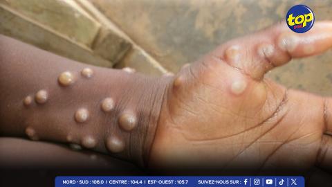 L’'épidémie de mpox s’aggrave en République démocratique du Congo :