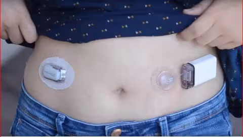 Pancréas artificiel, une prise en charge innovante du diabète à  La Réunion