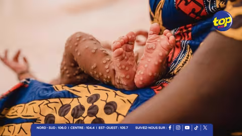 Mpox en Guinée-Bissau : les enfants particulièrement touchés lors de la première flambée dans le pays