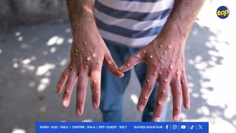 MPOX