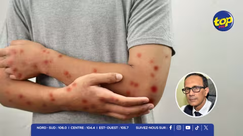 MPOX