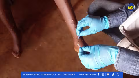 Mpox-ou-variole-du-singe