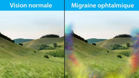 Migraine ophtalmique