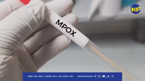Mpox à Maurice : deux cas suspects isolés à l’hôpital Victoria, résultats attendus sous-peu
